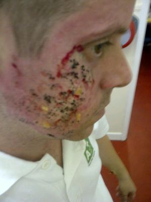 Explosion/ Blast Wound