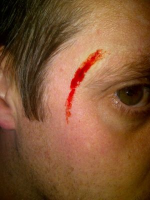 Head Wound